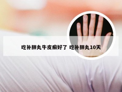 吃补肺丸牛皮癣好了 吃补肺丸10天