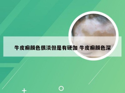 牛皮癣颜色很淡但是有硬伽 牛皮癣颜色深