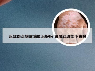 起红斑点银屑病能治好吗 银屑红斑能下去吗