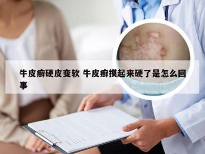 牛皮癣硬皮变软 牛皮癣摸起来硬了是怎么回事