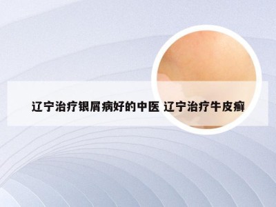 辽宁治疗银屑病好的中医 辽宁治疗牛皮癣