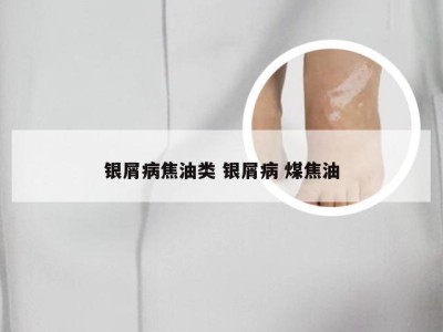 银屑病焦油类 银屑病 煤焦油