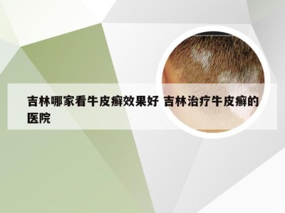 吉林哪家看牛皮癣效果好 吉林治疗牛皮癣的医院