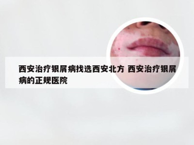 西安治疗银屑病找选西安北方 西安治疗银屑病的正规医院