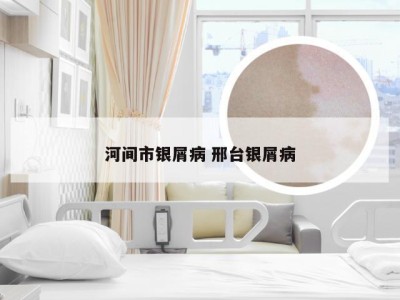 河间市银屑病 邢台银屑病