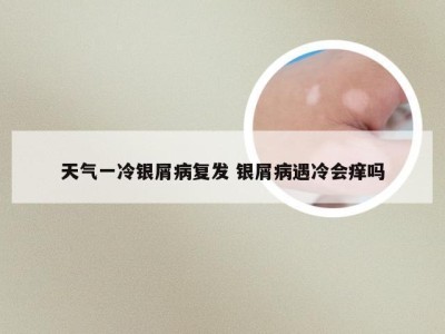 天气一冷银屑病复发 银屑病遇冷会痒吗