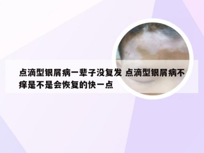 点滴型银屑病一辈子没复发 点滴型银屑病不痒是不是会恢复的快一点