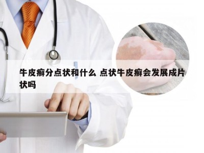 牛皮癣分点状和什么 点状牛皮癣会发展成片状吗