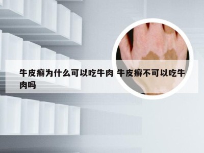 牛皮癣为什么可以吃牛肉 牛皮癣不可以吃牛肉吗