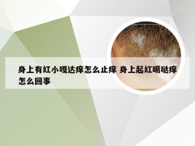 身上有红小嘎达痒怎么止痒 身上起红噶哒痒怎么回事