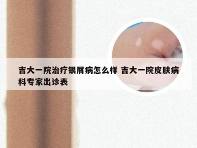 吉大一院治疗银屑病怎么样 吉大一院皮肤病科专家出诊表
