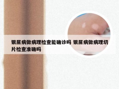 银屑病做病理检查能确诊吗 银屑病做病理切片检查准确吗