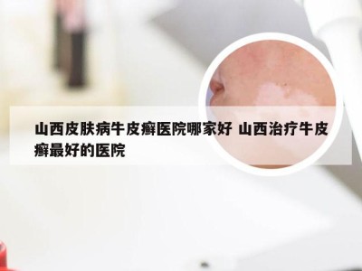山西皮肤病牛皮癣医院哪家好 山西治疗牛皮癣最好的医院