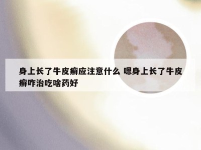 身上长了牛皮癣应注意什么 嗯身上长了牛皮癣咋治吃啥药好