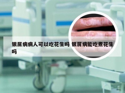 银屑病病人可以吃花生吗 银屑病能吃煮花生吗