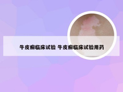 牛皮癣临床试验 牛皮癣临床试验用药