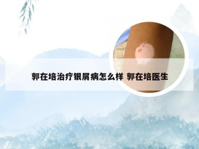 郭在培治疗银屑病怎么样 郭在培医生