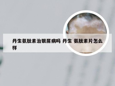 丹生氨肽素治银屑病吗 丹生 氨肽素片怎么样