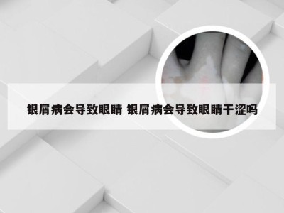 银屑病会导致眼睛 银屑病会导致眼睛干涩吗