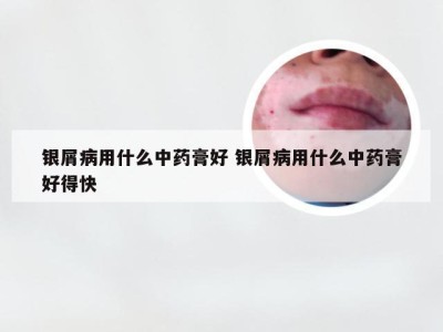 银屑病用什么中药膏好 银屑病用什么中药膏好得快