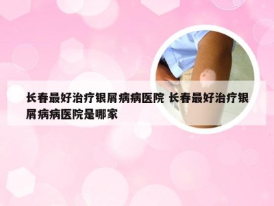 长春最好治疗银屑病病医院 长春最好治疗银屑病病医院是哪家