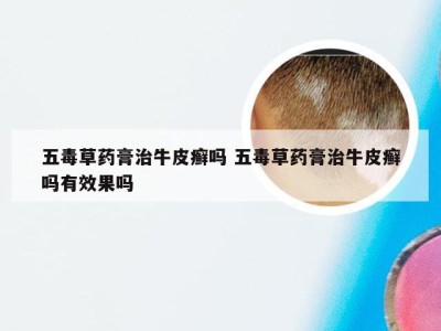 五毒草药膏治牛皮癣吗 五毒草药膏治牛皮癣吗有效果吗