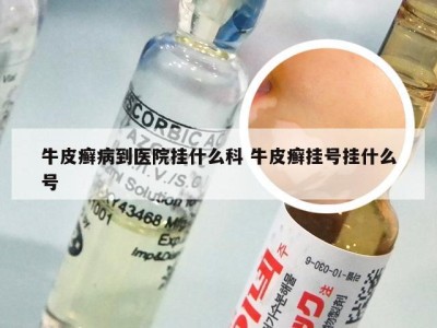 牛皮癣病到医院挂什么科 牛皮癣挂号挂什么号