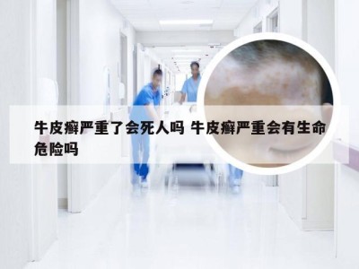 牛皮癣严重了会死人吗 牛皮癣严重会有生命危险吗
