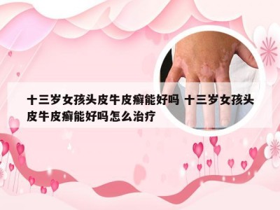 十三岁女孩头皮牛皮癣能好吗 十三岁女孩头皮牛皮癣能好吗怎么治疗