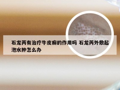 石龙芮有治疗牛皮癣的作用吗 石龙芮外敷起泡水肿怎么办