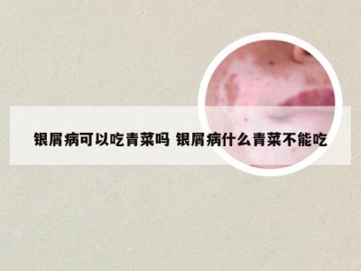 银屑病可以吃青菜吗 银屑病什么青菜不能吃