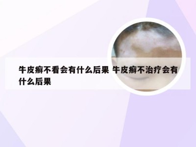 牛皮癣不看会有什么后果 牛皮癣不治疗会有什么后果