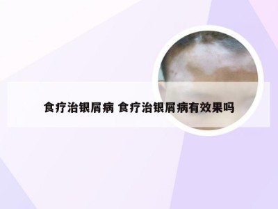 食疗治银屑病 食疗治银屑病有效果吗