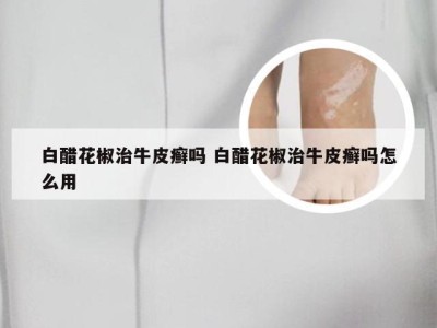 白醋花椒治牛皮癣吗 白醋花椒治牛皮癣吗怎么用