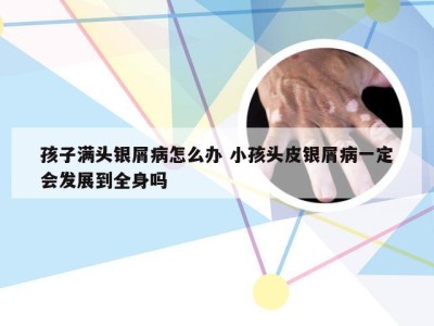 孩子满头银屑病怎么办 小孩头皮银屑病一定会发展到全身吗