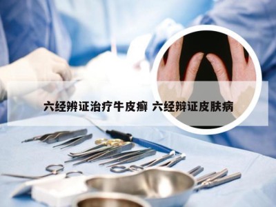 六经辨证治疗牛皮癣 六经辩证皮肤病
