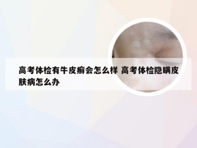 高考体检有牛皮癣会怎么样 高考体检隐瞒皮肤病怎么办