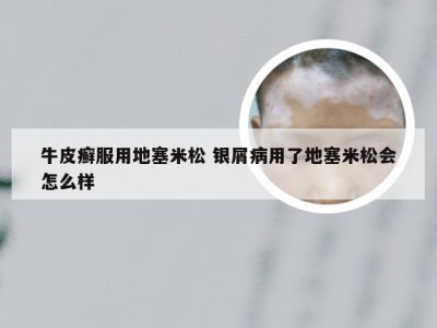 牛皮癣服用地塞米松 银屑病用了地塞米松会怎么样