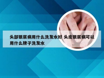 头部银屑病用什么洗发水好 头皮银屑病可以用什么牌子洗发水