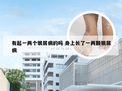 有起一两个银屑病的吗 身上长了一两颗银屑病