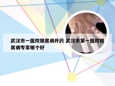 武汉市一医院银屑病开药 武汉市第一医院银屑病专家哪个好
