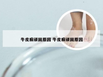 牛皮癣顽固原因 牛皮癣顽固原因