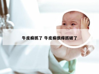 牛皮癣抓了 牛皮癣很痒抓破了