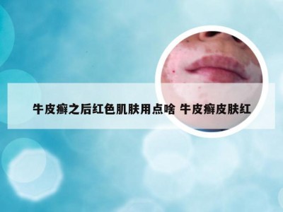 牛皮癣之后红色肌肤用点啥 牛皮癣皮肤红