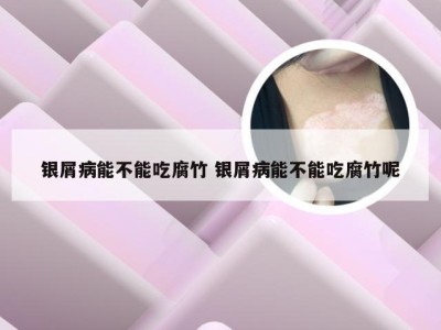 银屑病能不能吃腐竹 银屑病能不能吃腐竹呢