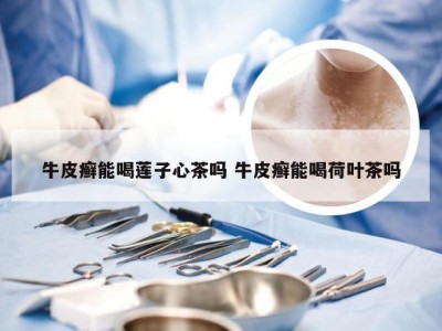 牛皮癣能喝莲子心茶吗 牛皮癣能喝荷叶茶吗