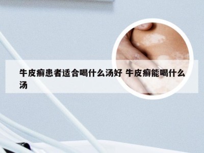 牛皮癣患者适合喝什么汤好 牛皮癣能喝什么汤