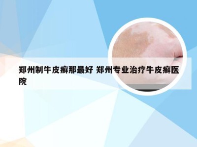 郑州制牛皮癣那最好 郑州专业治疗牛皮癣医院