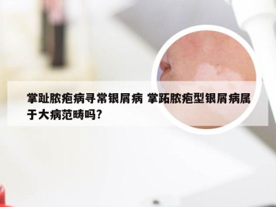 掌趾脓疱病寻常银屑病 掌跖脓疱型银屑病属于大病范畴吗?