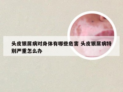 头皮银屑病对身体有哪些危害 头皮银屑病特别严重怎么办